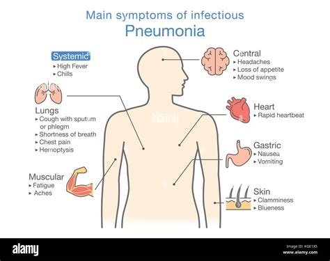 Diagram of main symptoms of infectious Pneumonia Stock Vector Image & Art - Alamy