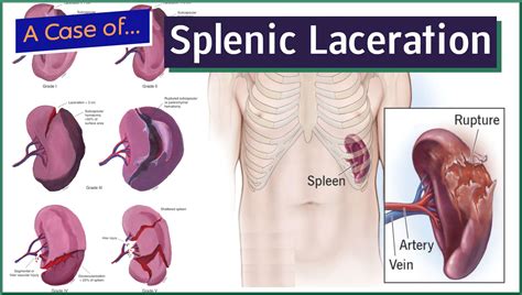 Splenic Laceration - MedEd Cases