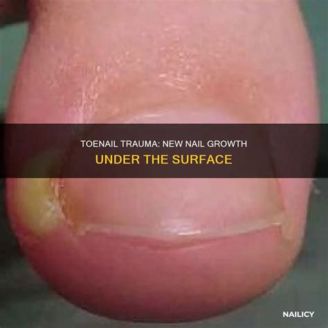 Toenail Trauma: New Nail Growth Under The Surface | Nailicy