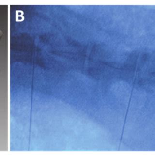 Image result for Disc Template Injection