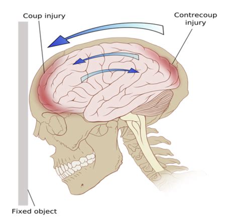 Image result for Contralateral Brain Injury