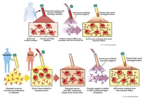 Image result for False Positive Coombs Test