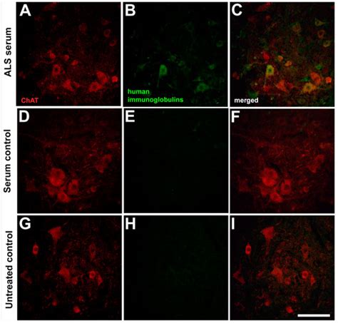 Passive Transfer of Blood Sera from ALS Patients with Identified ...