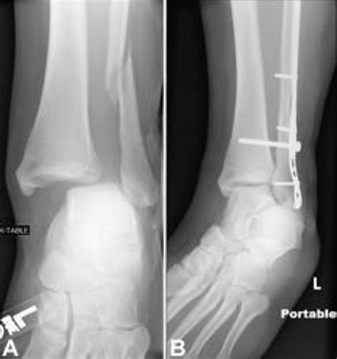 Broken Ankle - Fractured Ankle, Broken Foot, Stress Fracture Ankle