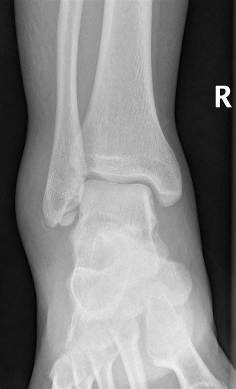 Ankle X-ray - Os subfibulare is an accessory ossicle that lies at the ...