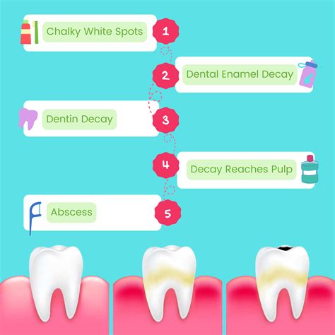 The Stages of Tooth Decay - Walton Blvd Dental