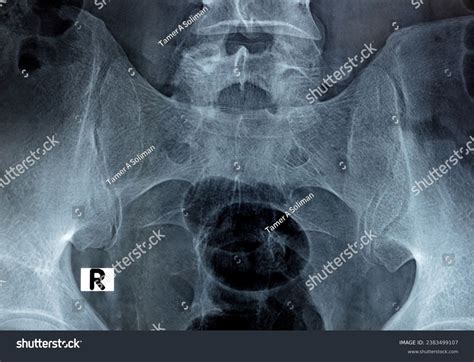 Xray Si Joint