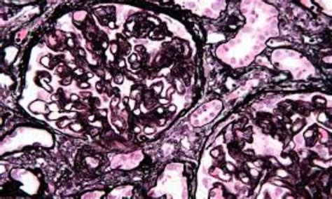 DMSA-induced membranous nephropathy in a patient with Wilson's disease ...