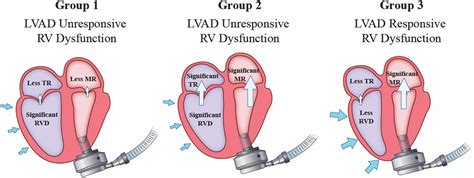 Frontiers | Role of the mitral valve in left ventricular assist device ...