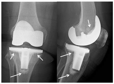PMMA-Based Bone Cements and the Problem of Joint Arthroplasty ...