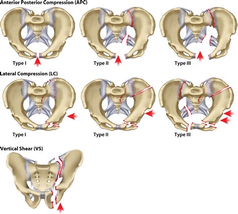 Pelvic Fractures — Kwak Talk
