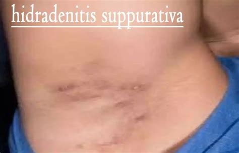 Efficacy of tetracyclines and clindamycin plus rifampicin for the ...