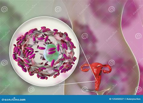Gardnerella Vaginalis. Vaginal Epithelial Clue Cell Coated With ...