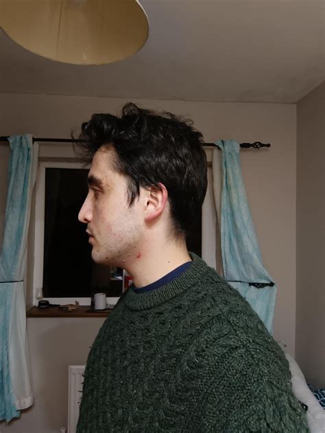 Is my mandible small/recessed? Do I have short face syndrome, or am I hyper-divergent? : r ...