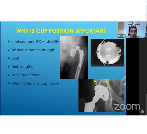 Acetabular Component Position in Total Hip Replacement — OrthopaedicPrinciples.com