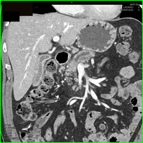 Carcinoma Pancreas with Dilated Pancreatic Duct - Pancreas Radiology Case Studies - CTisus CT ...