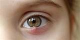 Conjunctivitis, styes, eyelid infection, etc.: The most common eye ...