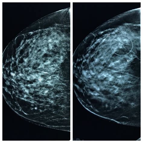 What Does A Normal Breast X Ray Look Like at Willie Mixon blog