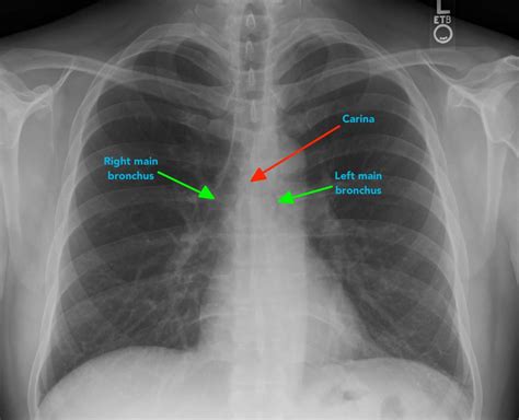 Chest X-ray Interpretation | A Structured Approach | Radiology | OSCE