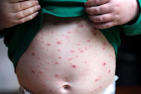 Introducing routine chickenpox jabs for children ‘could end risky pox ...