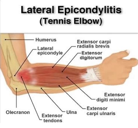 Tenderness In Elbow Joint