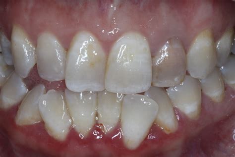 Image result for Discolored Tooth