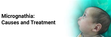 Micrognathia: Causes and Treatment