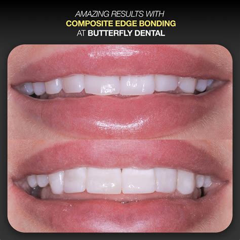 Composite Bonding in Altrincham, Manchester | Repair & Reshape Your Teeth