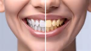 Dental Health: Dentists reveal 6 things that are proving to be harmful ...