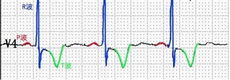 ECG Educator Blog : ST Segment Elevation Morphologies