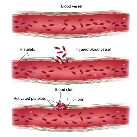 What is Thrombosis? | General information