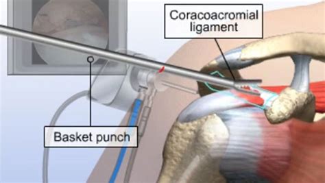 Image result for Subacromial Decompression Rotator Cuff Repair