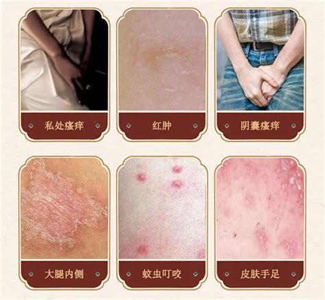 皮鲜王20g正品皮肤抑止菌痒膏真菌大腿内侧感染克星-阿里巴巴