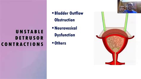 Image result for Videocystometrogram Procedure