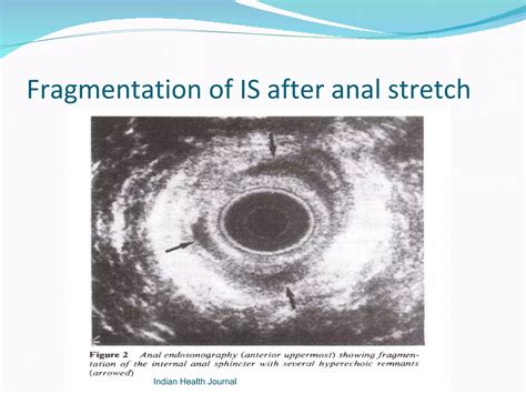Open lateral internal sphincterotomy | PPT