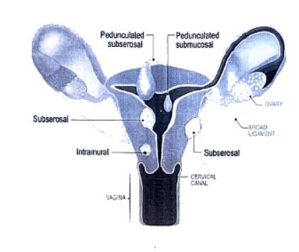 Uterine Fibroid - Medical Science Optional Notes for UPSC PDF Download