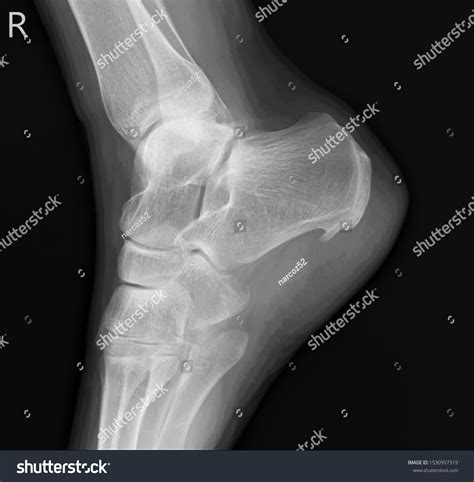 Heel Spur On Xray Right Heel Stock Photo 1530997319 | Shutterstock