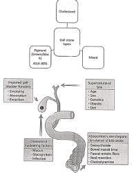 Gall Stones - Medical Science Optional Notes for UPSC PDF Download