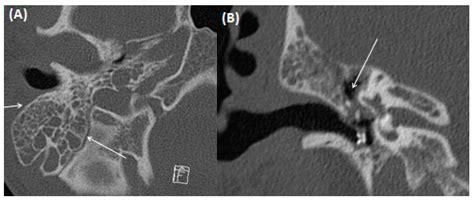 Imaging of Pathologies of the Temporal Bone and Middle Ear: Inflammatory Diseases, Their Mimics ...