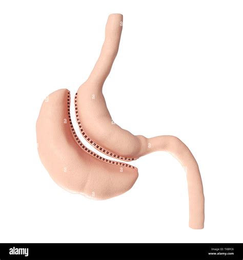 3d rendered medically accurate illustration of a vertical sleeve gastrectomy Stock Photo - Alamy