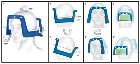 Posterior Fossa Approaches Using the Leksell Vantage Frame with a ...