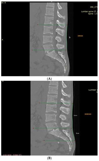 Schober Test and Its Modifications Revisited—What Are We Actually ...