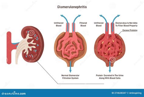 Poststreptococcal Glomerulonephritis Proteinuria at Winnie Norris blog