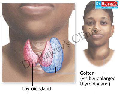 Homeopathic Treatment for Hyperthyroidism, Treatment of Hyperthyroidism