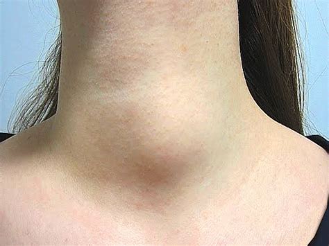 A lump in the neck can cause cancer, know its early symptoms – Times Bull