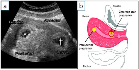 Uterine Scarring After C-Section Infertility at Jonathan Hoffman blog