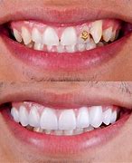 Image result for Dental Veneers Before and After