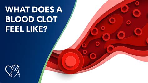 What Does A Blood Clot Feel Like In The Neck at Clara Stamps blog