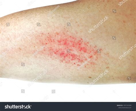 Bruising Bleeding Caused By Scratching Due Stock Photo 1357101878 ...