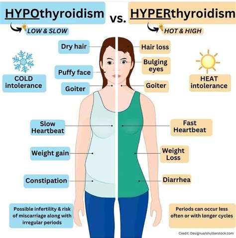 Dina Hussein ElAdly on LinkedIn: Hypothyroidism vs Hyperthyroidism # ...